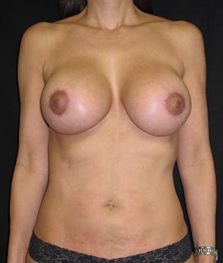 Liposuction Before & After Gallery - Patient 122909116 - Image 2