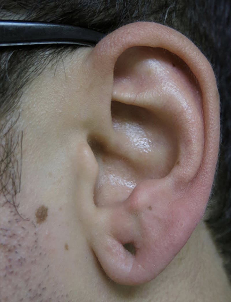 Ear Lobe Repair and Ear Reconstruction Before & After Gallery - Patient 122909108 - Image 3