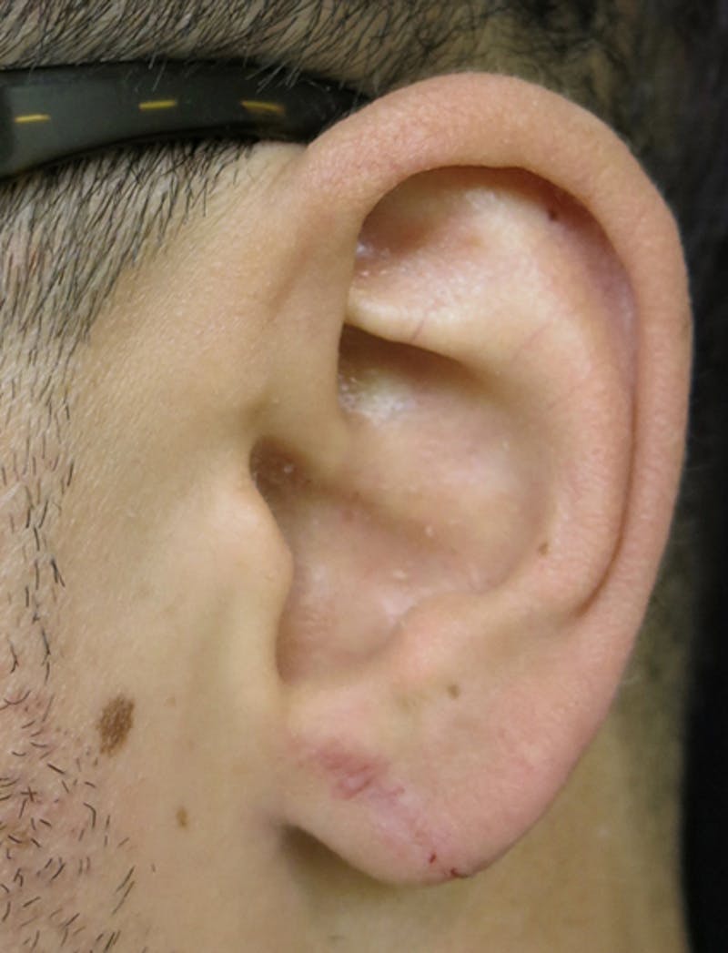 Ear Lobe Repair and Ear Reconstruction Before & After Gallery - Patient 122909108 - Image 4