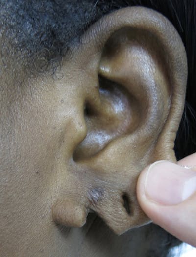 Ear Lobe Repair and Ear Reconstruction Before & After Gallery - Patient 122909113 - Image 1