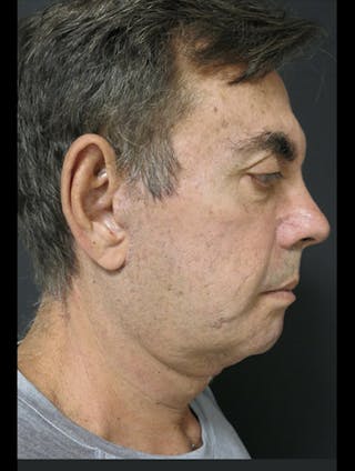 Facial Fat Grafting Before & After Gallery - Patient 122909112 - Image 12