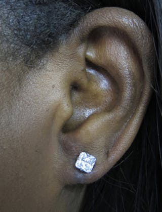Ear Lobe Repair and Ear Reconstruction Before & After Gallery - Patient 122909113 - Image 2