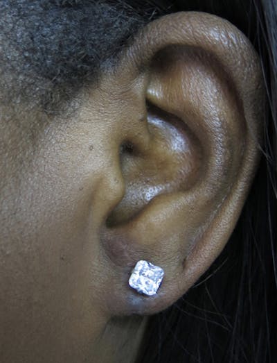 Ear Lobe Repair and Ear Reconstruction Before & After Gallery - Patient 122909113 - Image 2