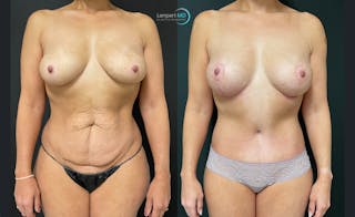 Tummy Tuck Before & After Gallery - Patient 122909119 - Image 1