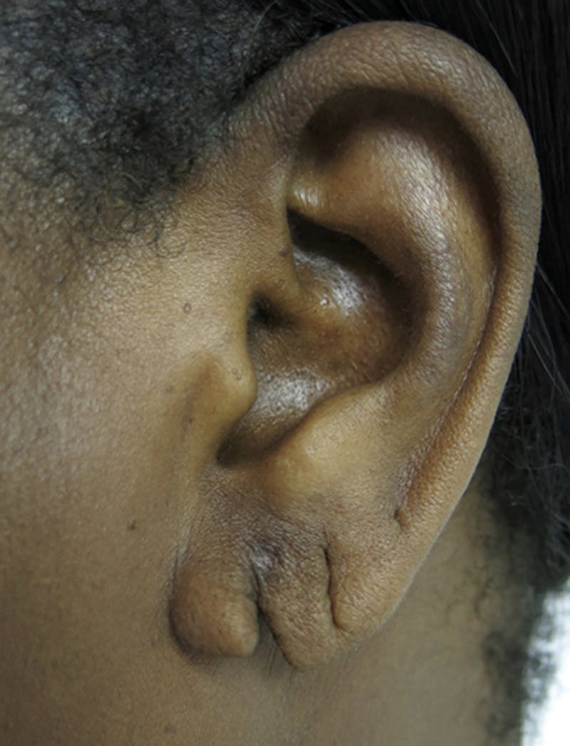 Ear Lobe Repair and Ear Reconstruction Before & After Gallery - Patient 122909113 - Image 3