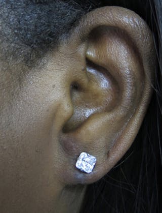 Ear Lobe Repair and Ear Reconstruction Before & After Gallery - Patient 122909113 - Image 4