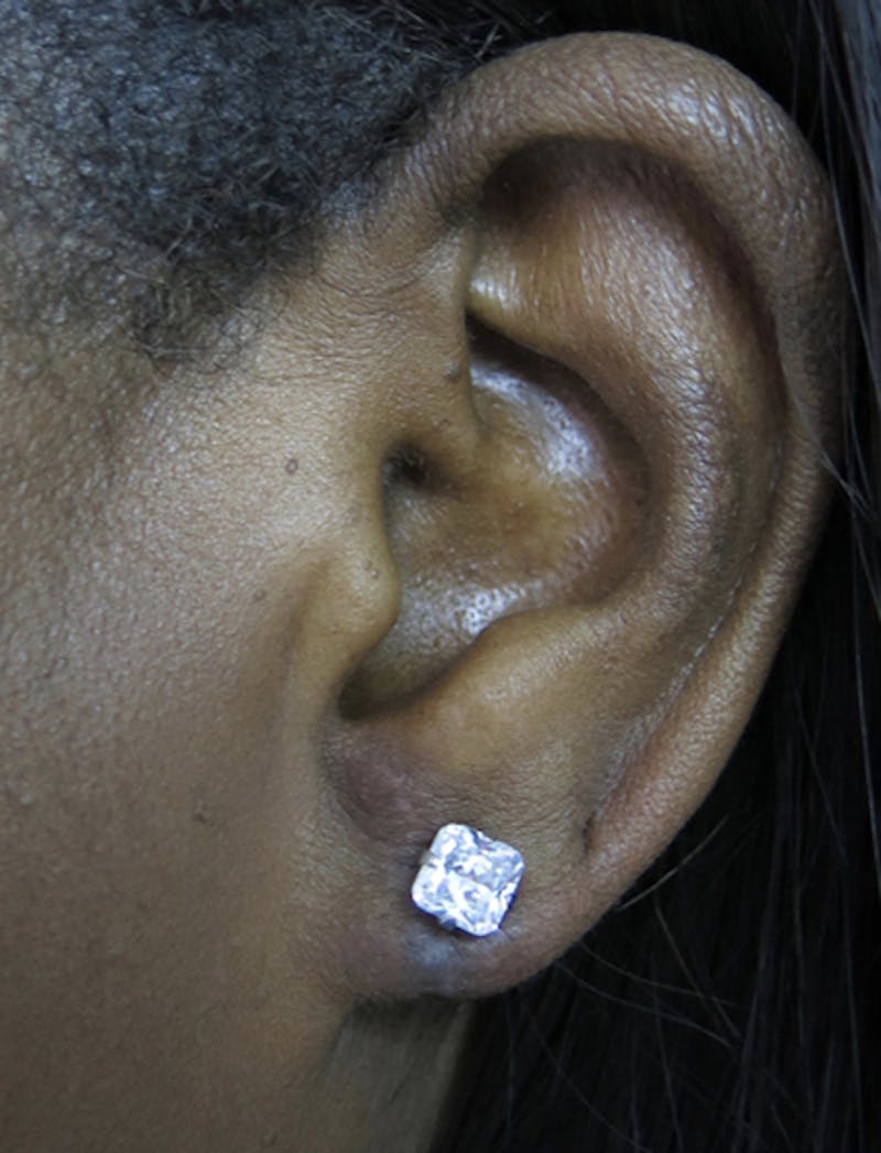 Ear Lobe Repair and Ear Reconstruction Before & After Gallery - Patient 122909113 - Image 4