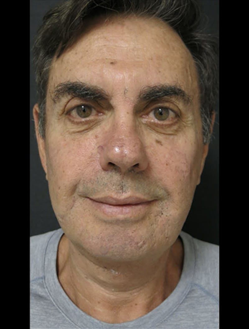 Facial Fat Grafting Before & After Gallery - Patient 122909112 - Image 16