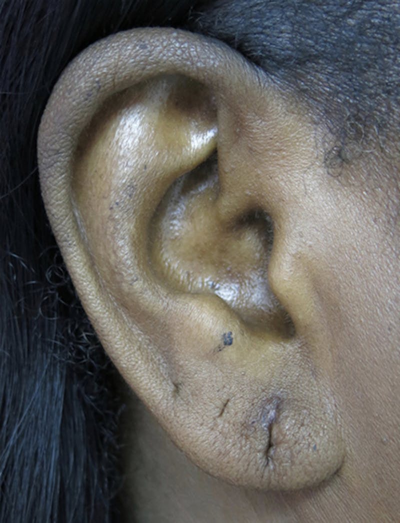 Ear Lobe Repair and Ear Reconstruction Before & After Gallery - Patient 122909113 - Image 5