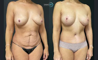 Tummy Tuck Before & After Gallery - Patient 122909119 - Image 2