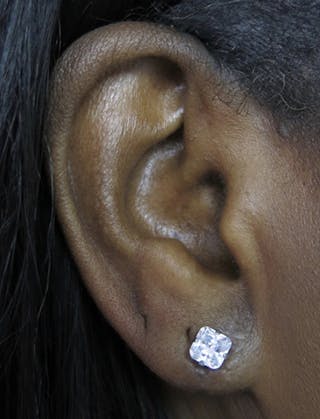 Ear Lobe Repair and Ear Reconstruction Before & After Gallery - Patient 122909113 - Image 6