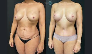 Tummy Tuck Before & After Gallery - Patient 122909119 - Image 3