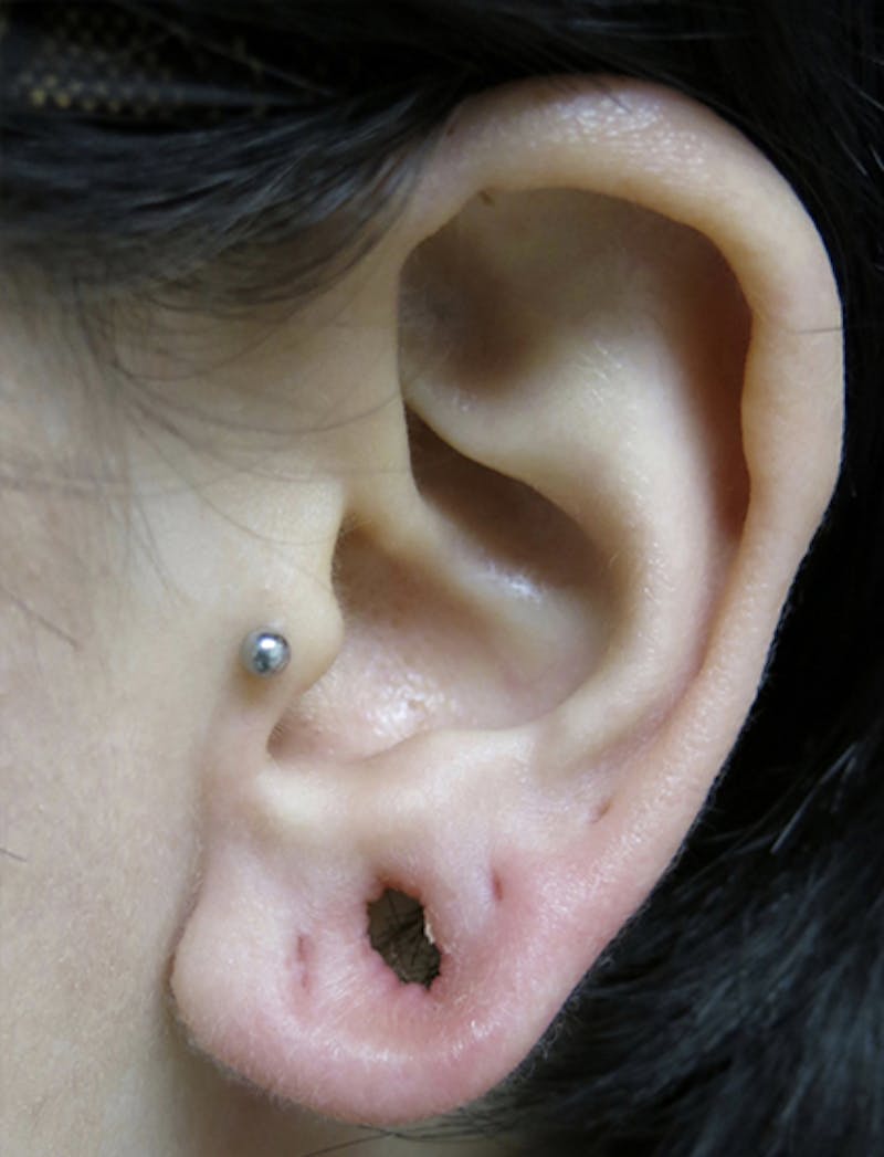 Ear Lobe Repair and Ear Reconstruction Before & After Gallery - Patient 122909118 - Image 1