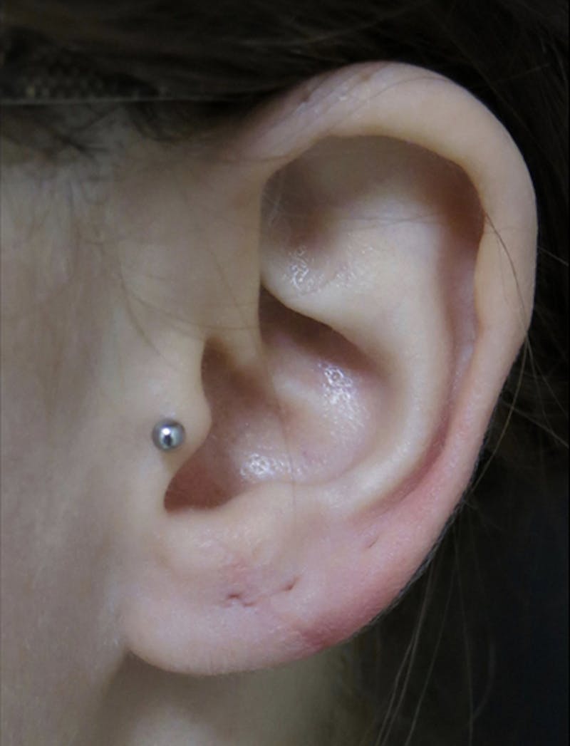 Ear Lobe Repair and Ear Reconstruction Before & After Gallery - Patient 122909118 - Image 2