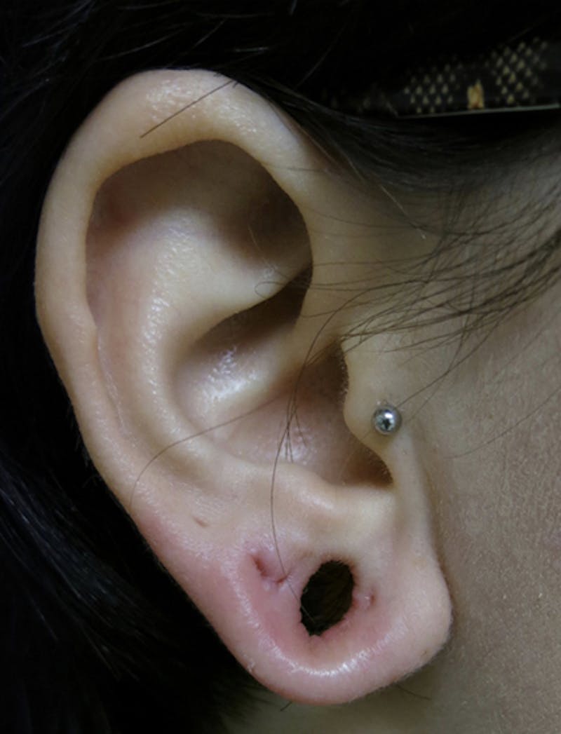 Ear Lobe Repair and Ear Reconstruction Before & After Gallery - Patient 122909118 - Image 3