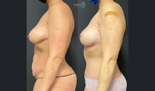 Lower Body Lift Before & After Gallery - Patient 407411 - Image 4