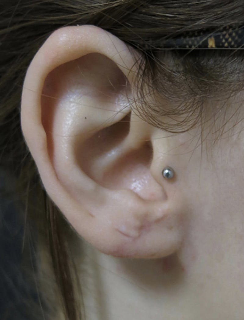 Ear Lobe Repair and Ear Reconstruction Before & After Gallery - Patient 122909118 - Image 4