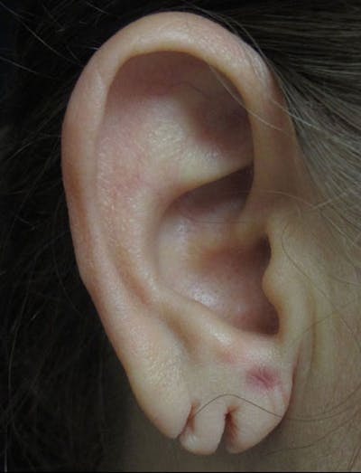 Ear Lobe Repair and Ear Reconstruction Before & After Gallery - Patient 122909121 - Image 1