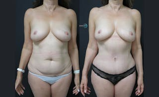 Tummy Tuck Before & After Gallery - Patient 122909124 - Image 1