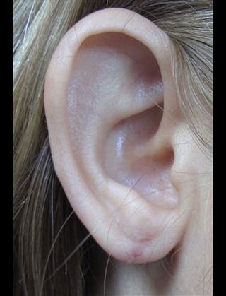 Ear Lobe Repair and Ear Reconstruction Before & After Gallery - Patient 122909121 - Image 2
