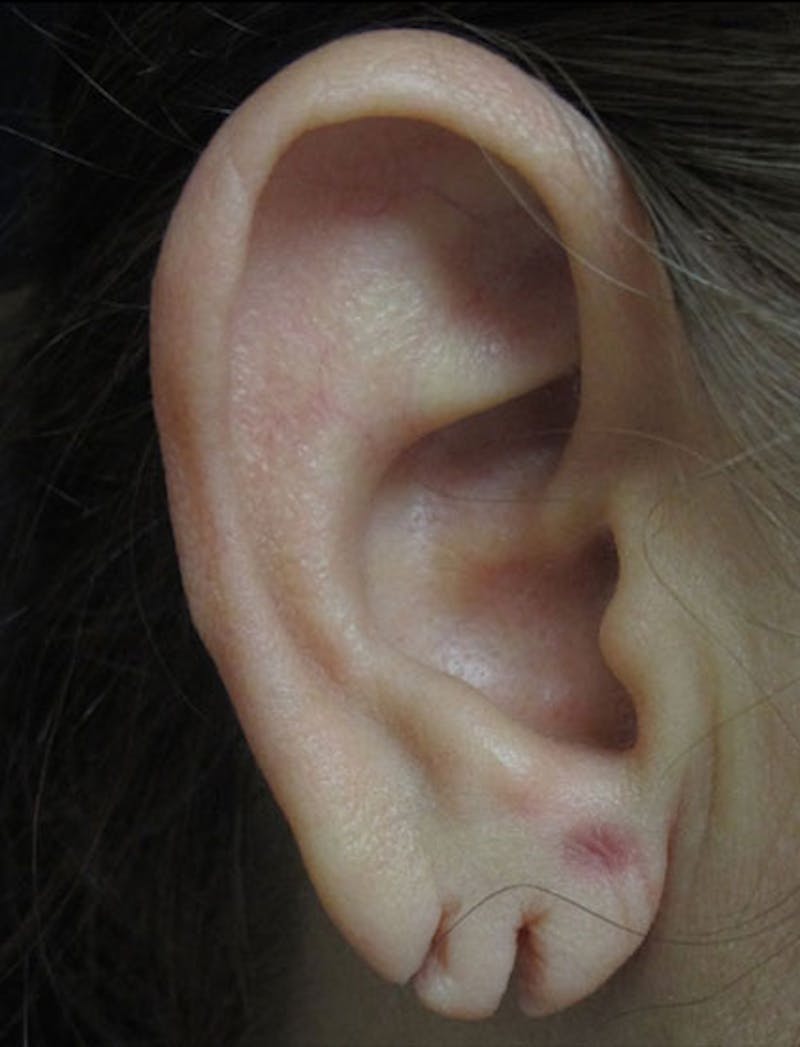 Ear Lobe Repair and Ear Reconstruction Before & After Gallery - Patient 122909121 - Image 3