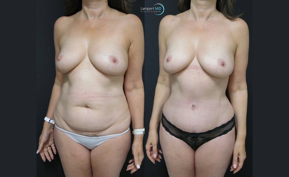 Tummy Tuck Before & After Gallery - Patient 122909124 - Image 2