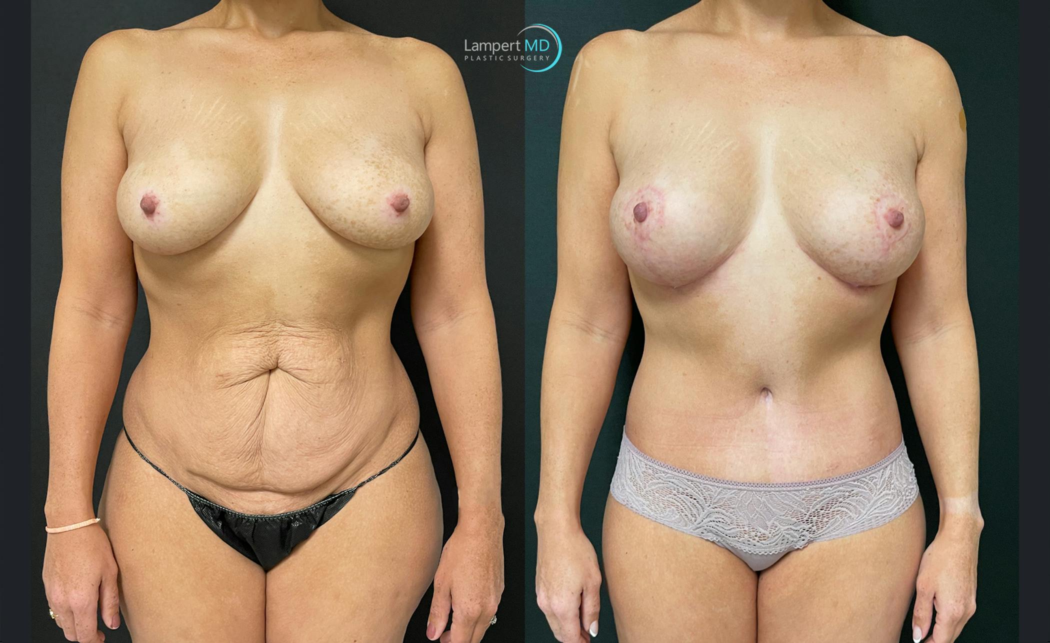 Before and after Tummy Tuck surgery in Miami with Dr. Lampert