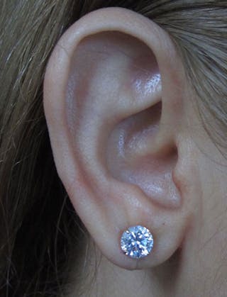 Ear Lobe Repair and Ear Reconstruction Before & After Gallery - Patient 122909121 - Image 4