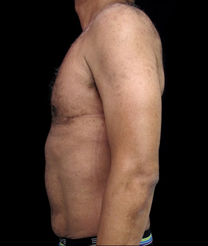 Liposuction Before & After Gallery - Patient 122909120 - Image 6