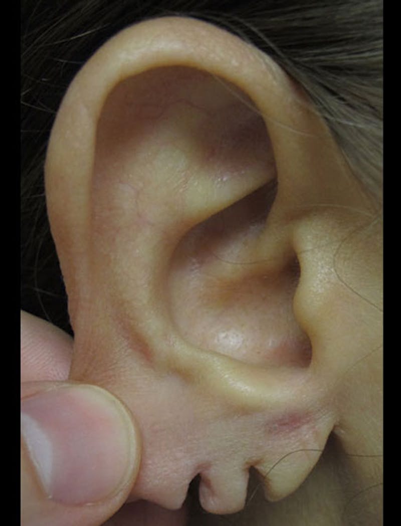 Ear Lobe Repair and Ear Reconstruction Before & After Gallery - Patient 122909121 - Image 5
