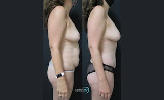 Tummy Tuck Before & After Gallery - Patient 122909124 - Image 3