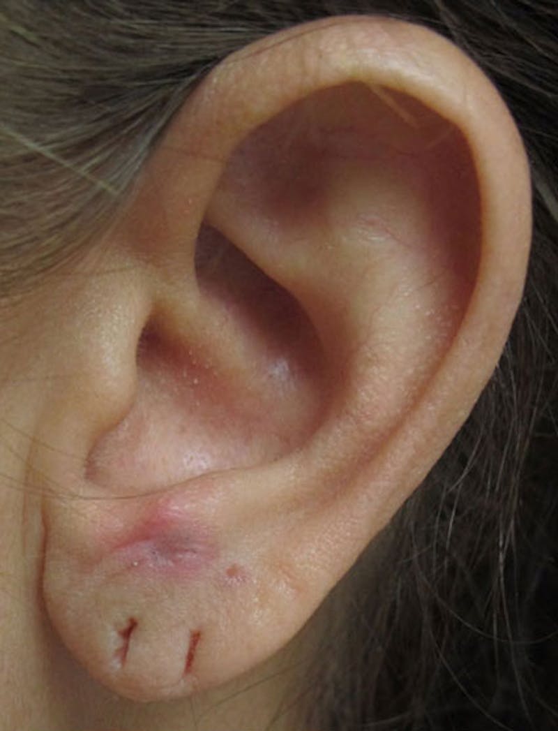 Ear Lobe Repair and Ear Reconstruction Before & After Gallery - Patient 122909121 - Image 7