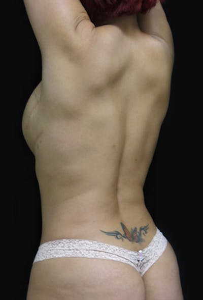 Liposuction Before & After Gallery - Patient 122909122 - Image 2