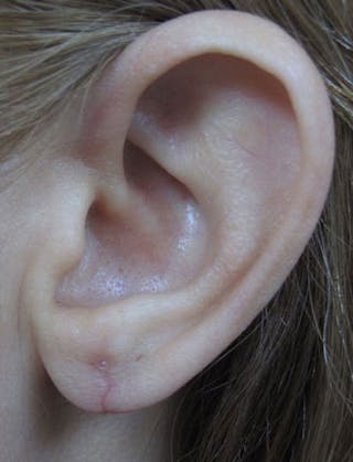 Ear Lobe Repair and Ear Reconstruction Before & After Gallery - Patient 122909121 - Image 8