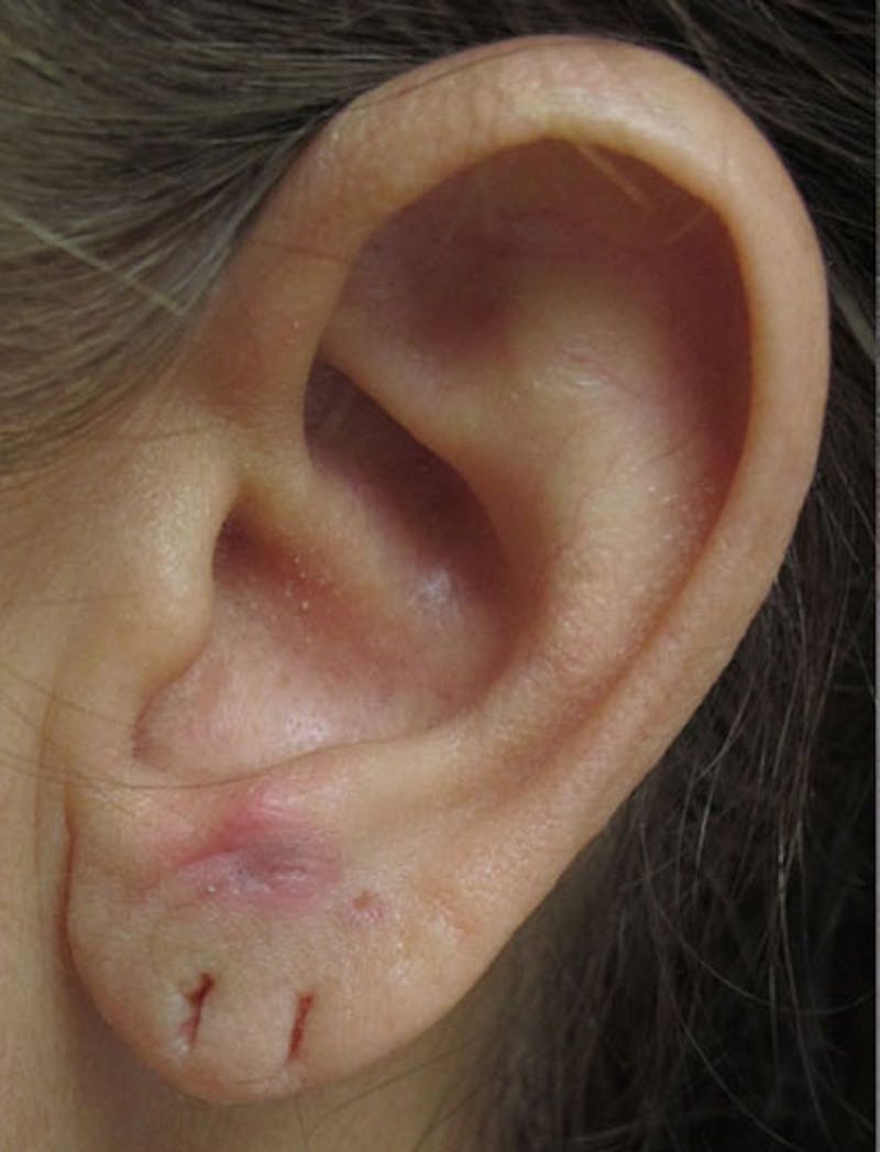 Ear Lobe Repair and Ear Reconstruction Before & After Gallery - Patient 122909121 - Image 9