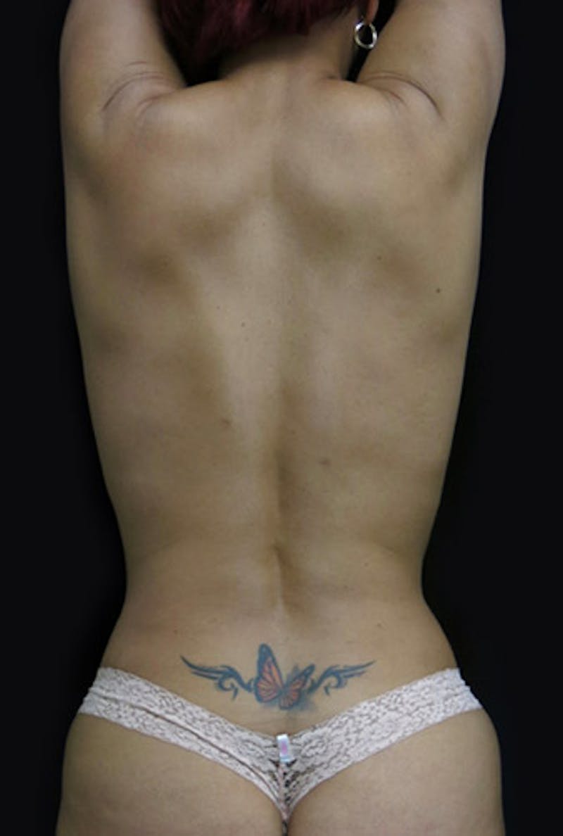 Liposuction Before & After Gallery - Patient 122909122 - Image 4