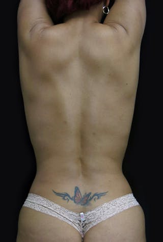Liposuction Before & After Gallery - Patient 122909122 - Image 4