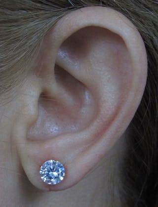 Ear Lobe Repair and Ear Reconstruction Before & After Gallery - Patient 122909121 - Image 10