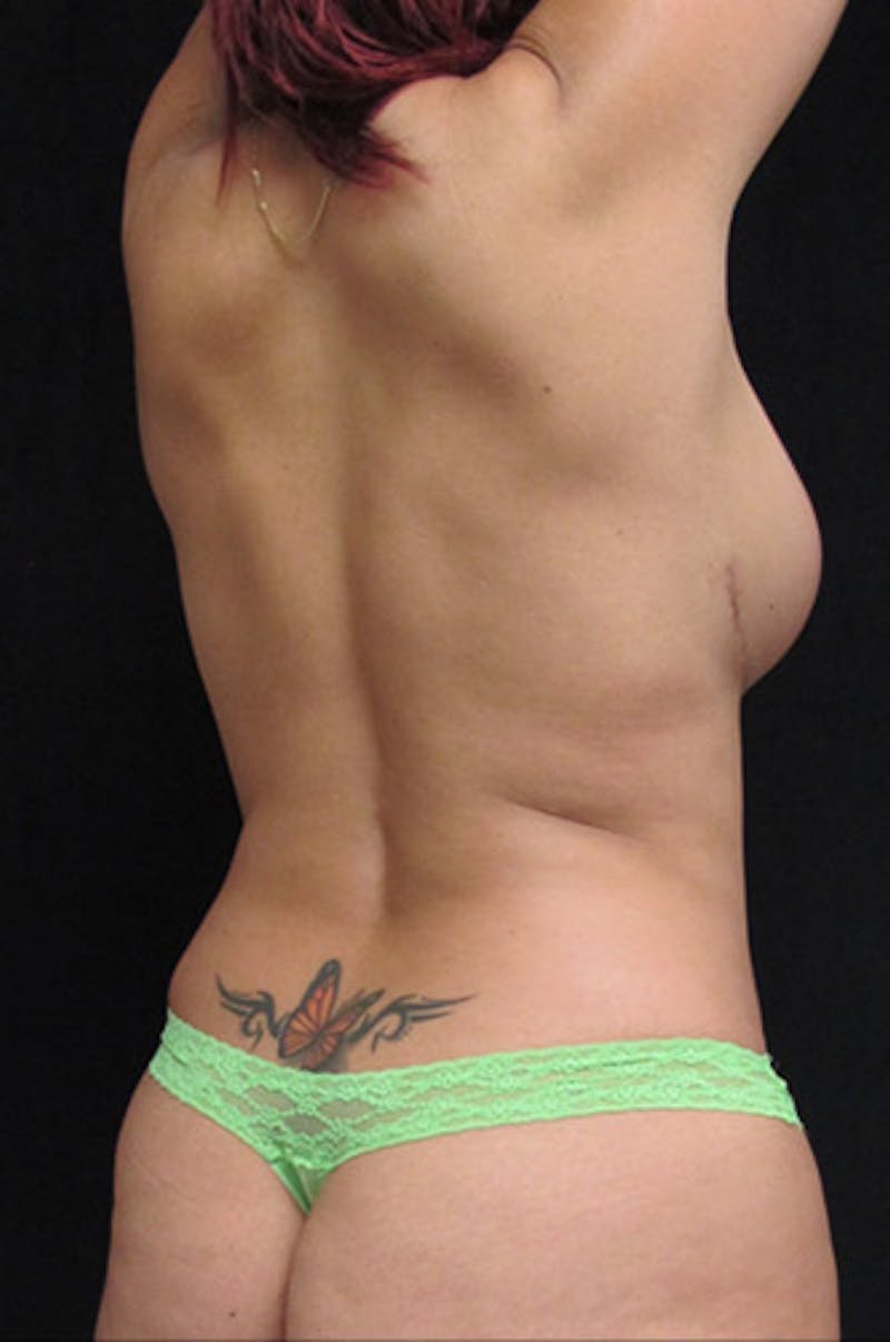 Liposuction Before & After Gallery - Patient 122909122 - Image 5