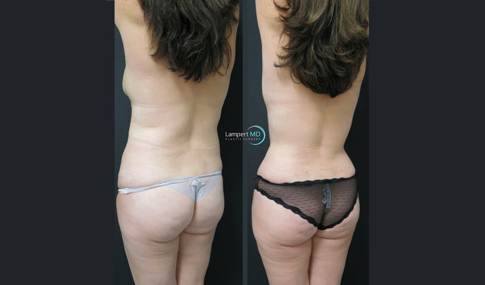 Tummy Tuck Before & After Gallery - Patient 122909124 - Image 5