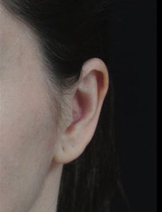 Ear Lobe Repair and Ear Reconstruction Before & After Gallery - Patient 122909128 - Image 4