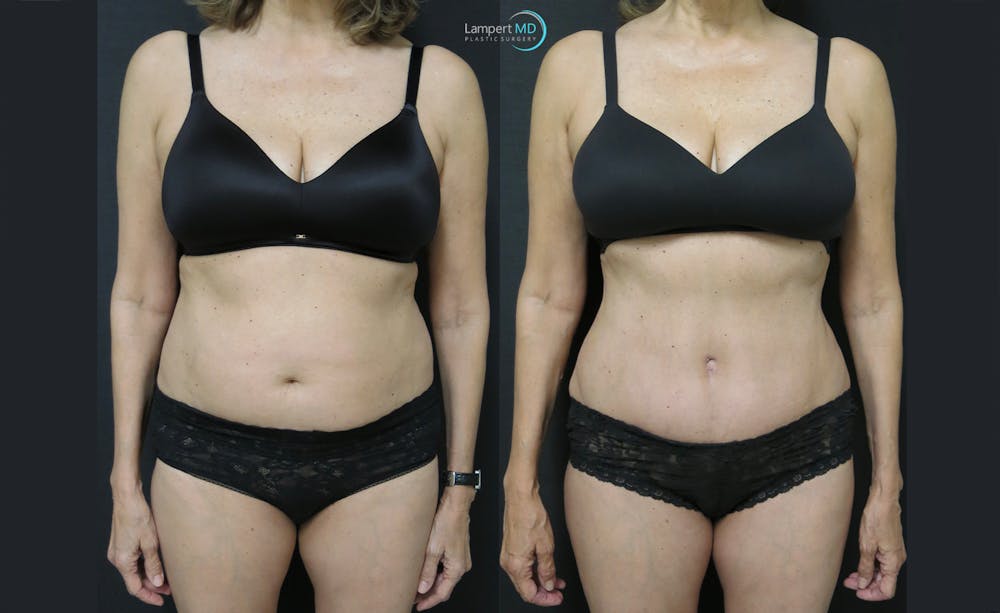 Tummy Tuck Before & After Gallery - Patient 122909138 - Image 1