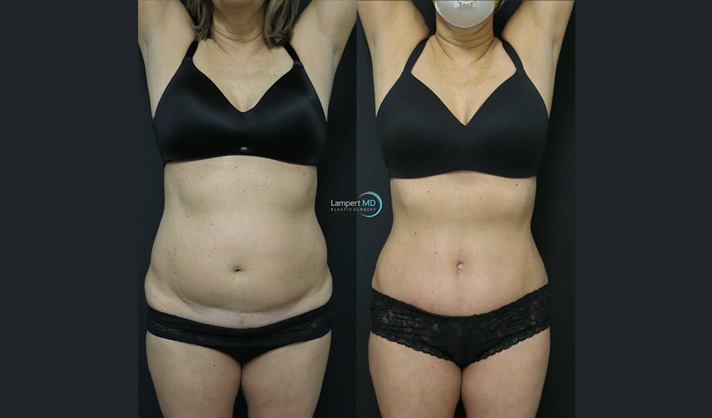 Tummy Tuck Before & After Gallery - Patient 122909138 - Image 2