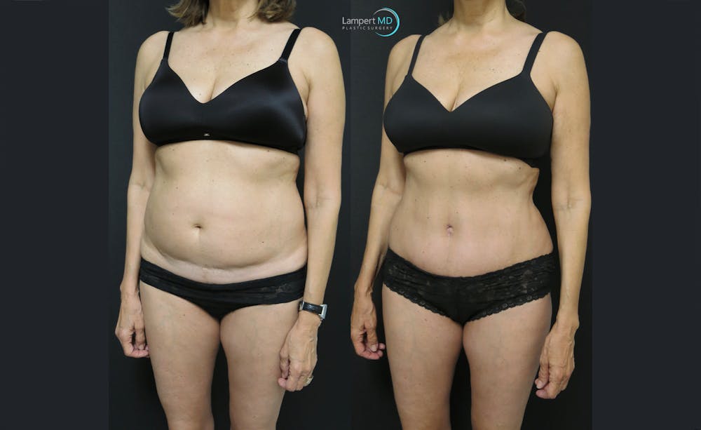 Tummy Tuck Before & After Gallery - Patient 122909138 - Image 3