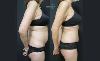 Tummy Tuck Before & After Gallery - Patient 122909138 - Image 4