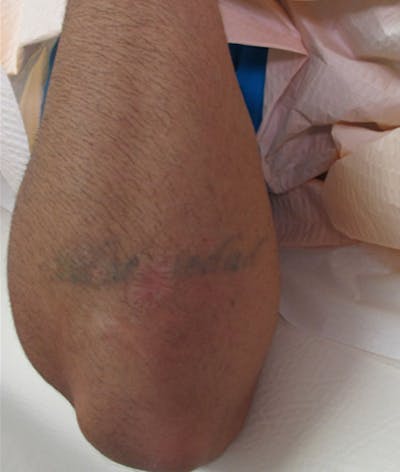 Tattoo Removal Before & After Gallery - Patient 122909137 - Image 1