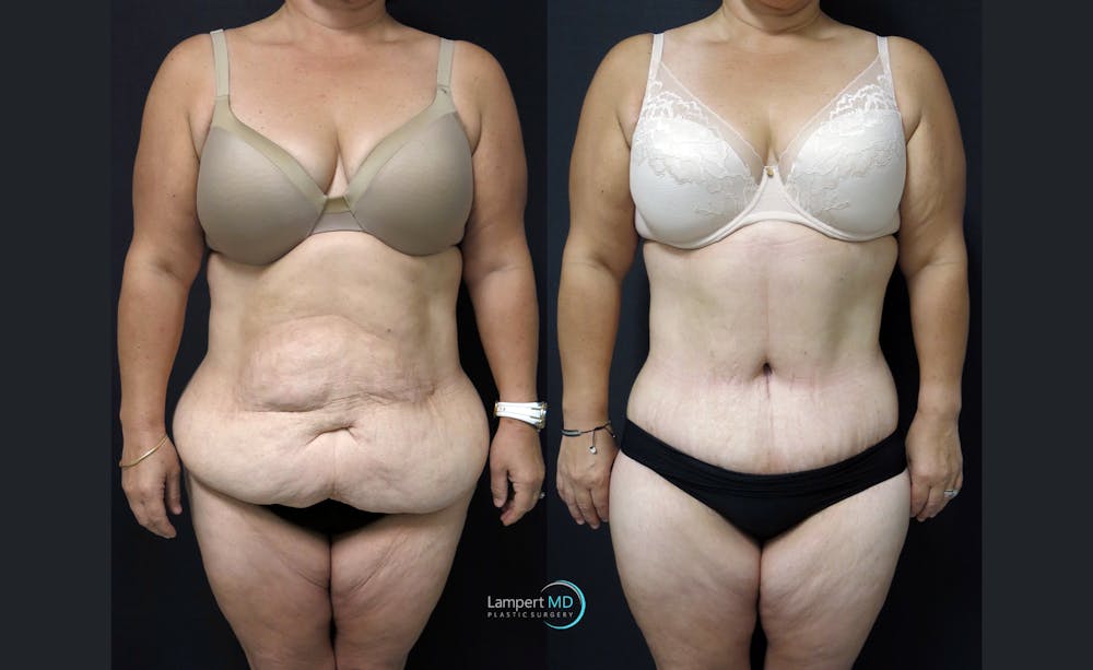 Tummy Tuck Before & After Gallery - Patient 122909145 - Image 1