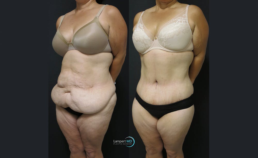 Tummy Tuck Before & After Gallery - Patient 122909145 - Image 2