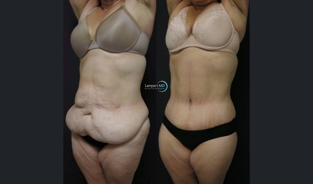 Tummy Tuck Before & After Gallery - Patient 122909145 - Image 3