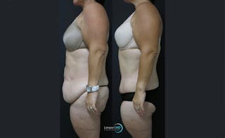 Tummy Tuck Before & After Gallery - Patient 122909145 - Image 4